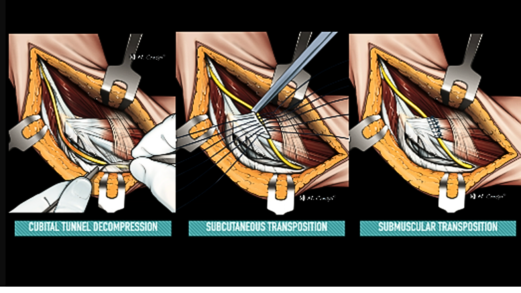 Cubital Tunnel Syndrome A Global Solution In Miami FL DrBadia