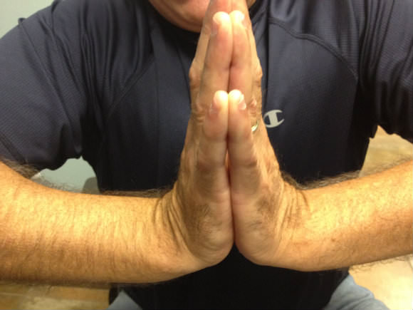 Shattered Wrist Broken Wrist Volar Plate Fixation Wrist Surgeon Dr. Alejandro Badia Hand To Shoulder Wrist Hospital - Toy Maker regains Hand Use - Miami, FL