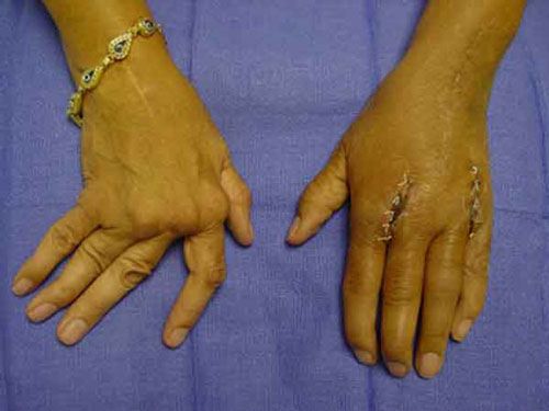 Rheumatoid Arthritis Hand Cure & Treatment Dr. Alejandro Badia Hand And Finger Doctor Replacement Arthroplasties of Metacarpophalangeal Joints Knuckle Joints Miami