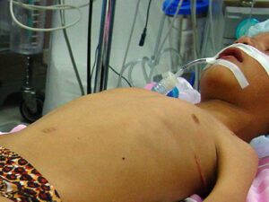 Arthrogryposis Congenita Multiplex Orthopedic Dr. Alejandro Badia Gracilis Muscle Transfer Elbow and Arm Surgeon Hand to Shoulder Center Doral. FL