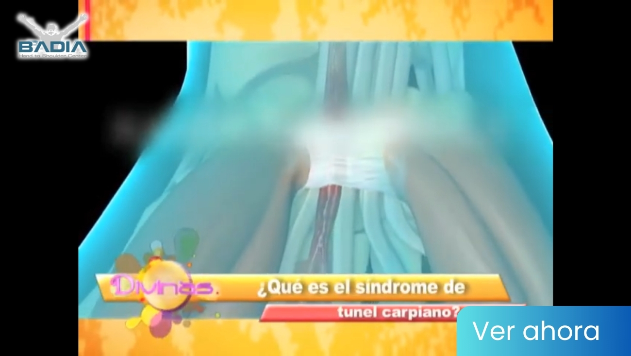 ¿Que es el síndrome de Túnel Carpiano?