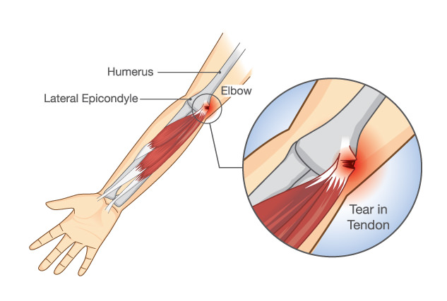 Image of tennis and golfers elbow