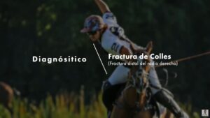 fractura de colles - polista argentino