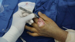 surgiwrap adhesion barrier