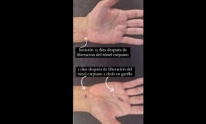 sindrome-del-tunel-carpiano-pic