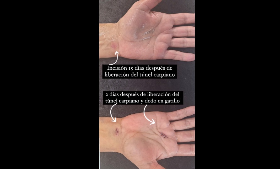 sindrome-del-tunel-carpiano-pic