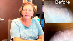 This Patient Had Both Her Shoulders Replaced