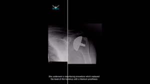 This patient had bilateral shoulder replacements (shoulder resurfacing)