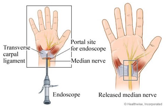 treatment for Carpal Tunnel Syndrome
