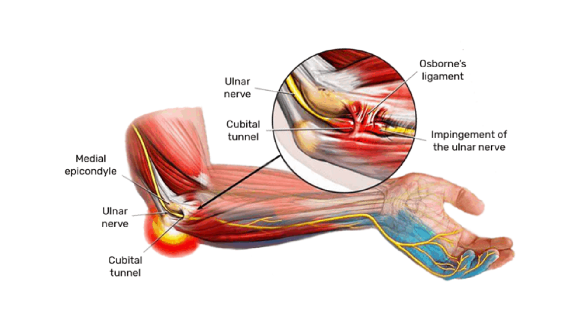 elbow pain