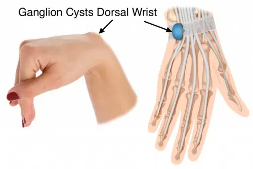 Dorsal Wrist Ganglia