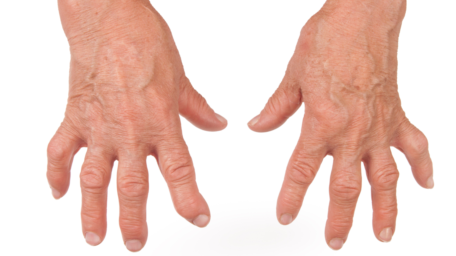 Rheumatic Arthritis