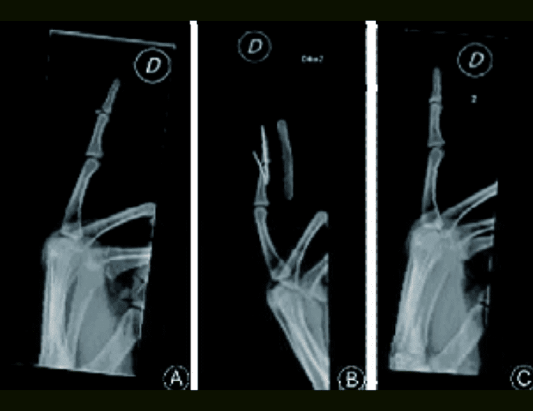 mallet finger fracture xray
