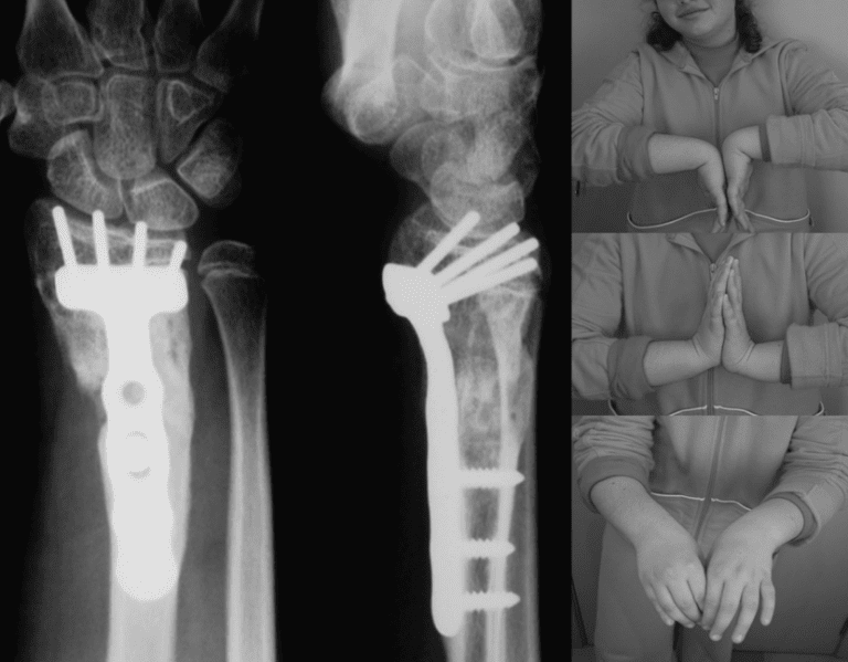 Corrective osteotomy in Pediatrics - distal radius