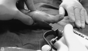 basal joint arthritis procedure