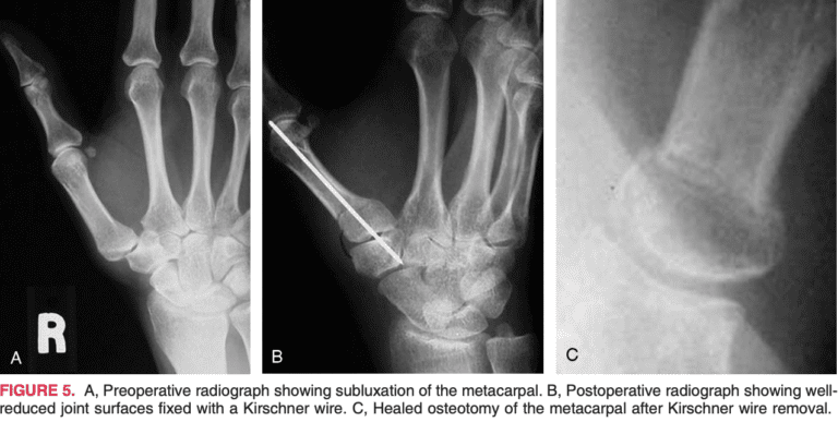 BASAL JOINT ARTHRITIS