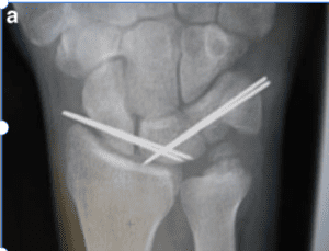 Tears of the Scapholunate & Lunotriquetral Ligaments - wrist with pins