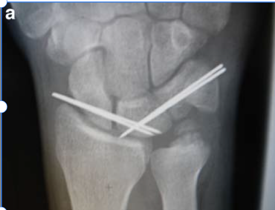 Tears of the Scapholunate & Lunotriquetral Ligaments - wrist with pins