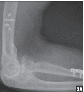 Management of Elbow Ankylosis - elbow xray