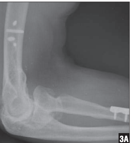 Management of Elbow Ankylosis - elbow xray