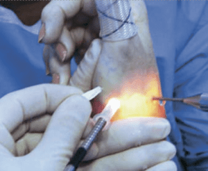 small joint arthroscopy of the thumb