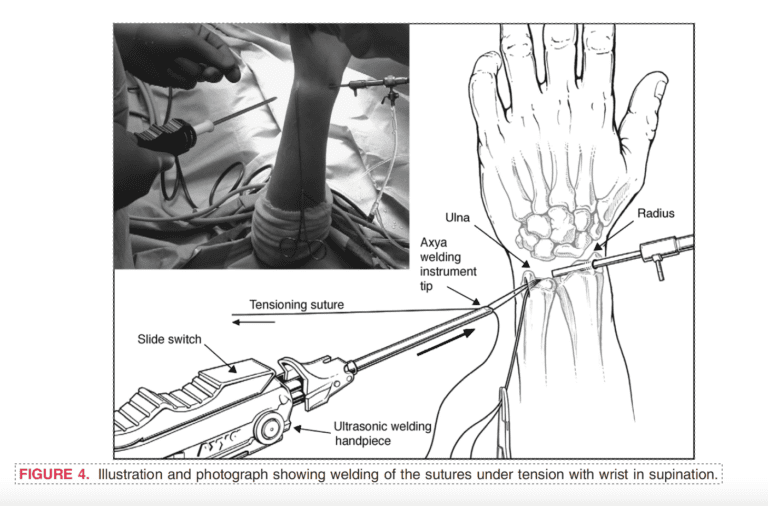 Wrist arthroscopy animation