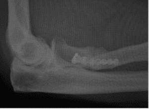 proximal radial head fracture xray of plating