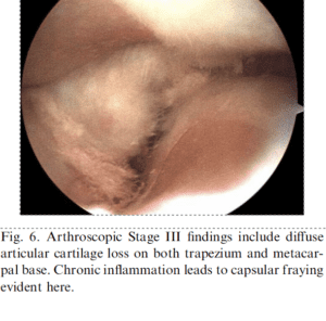 arthroscopic stage 3 scope image