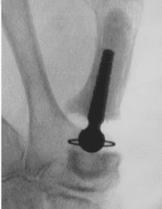 Thumb Carpometacarpal Joint Osteoarthritis - checking implant stability under fluoroscopy