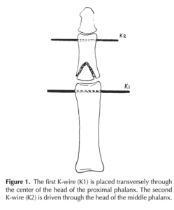 Dynamic intradigital external fixation for proximal interphalangeal joint fracture dislocations