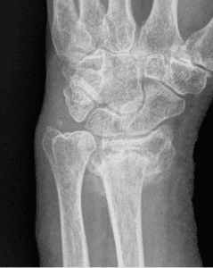 distal radius malunion