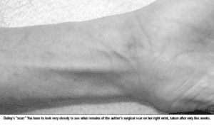 Surgical Procedure for Carpal Tunnel Syndrome