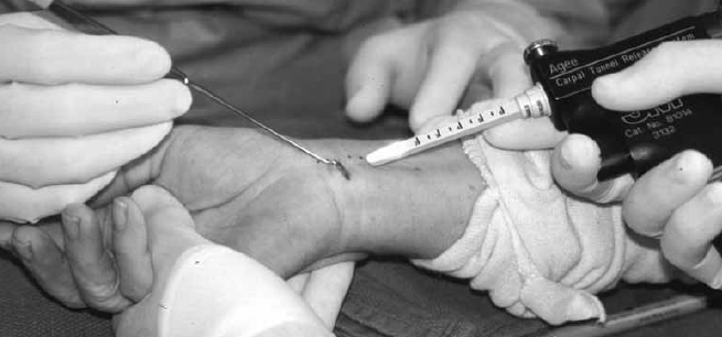 endoscopic carpal tunnel release