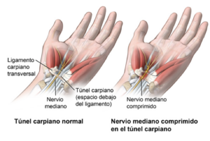 Sindrome del tunel carpiano