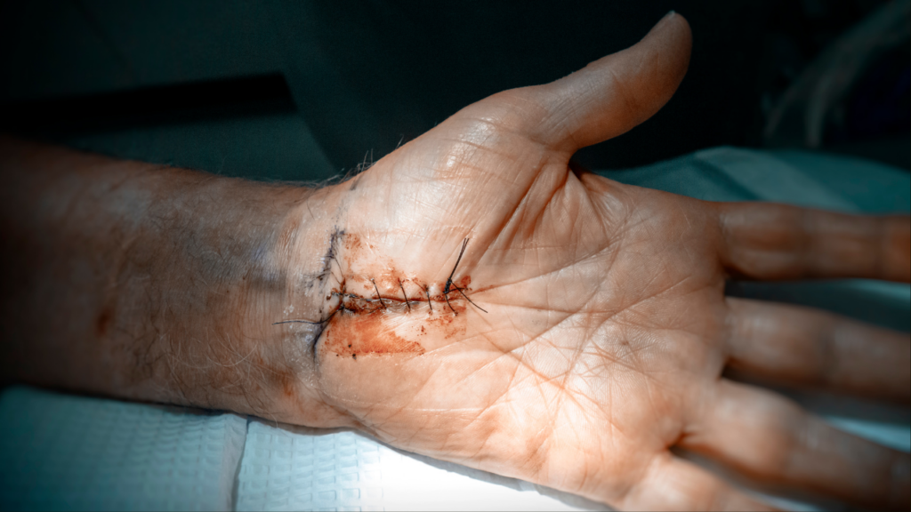 carpal tunnel release scar