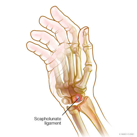 wrist sprain scapholunate tear