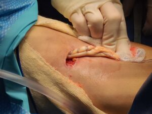 distal biceps repair with arthrex allograft