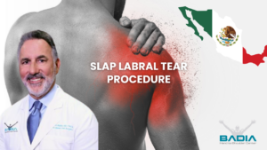 slap labral tera fro mexico