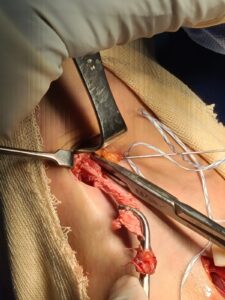 Ruptured distal biceps prior to repair