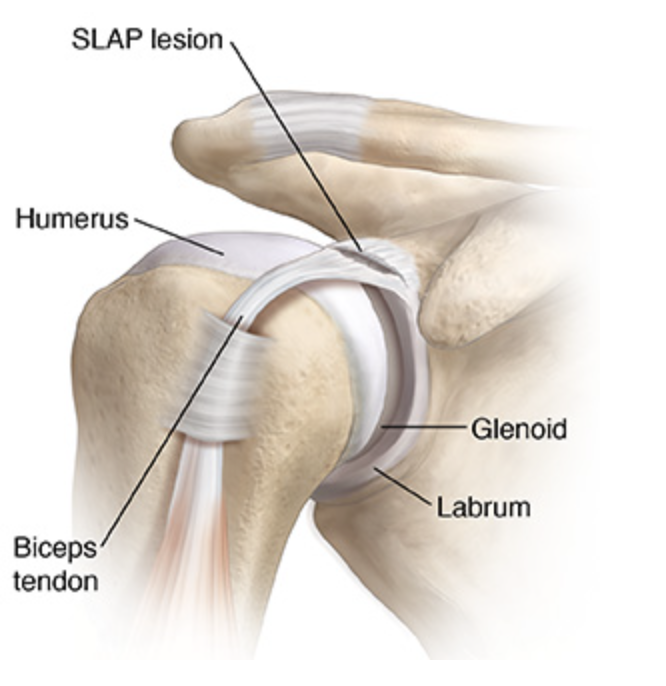 Screen Shot 2023-08-25 at 10.24.03 AM Superior labrum tear