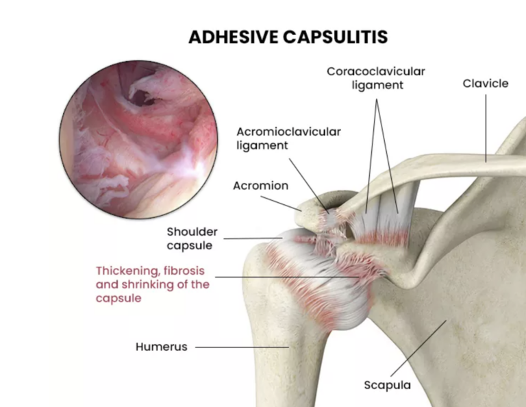 what is frozen shoulder?