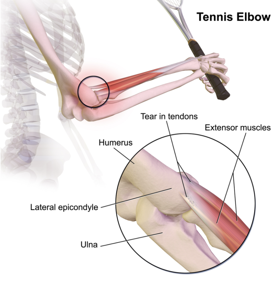 Screen Shot 2023-08-25 at 2.55.09 PM tennis elbow anatomy