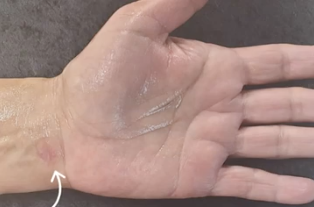 scar after carpal tunnel release endoscopic