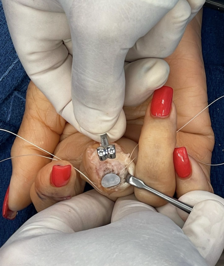 Osteoarthritis patient had a hemiarthroplasty!