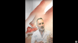 Total joint replacement or hemi (Partial joint replacement) ? Which one do I need?