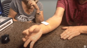 A Patient Starts Using His Hand After Thumb Arthroplasty