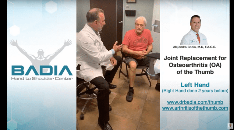 Joint Replacement for Osteoarthritis (OA) of the Thumb