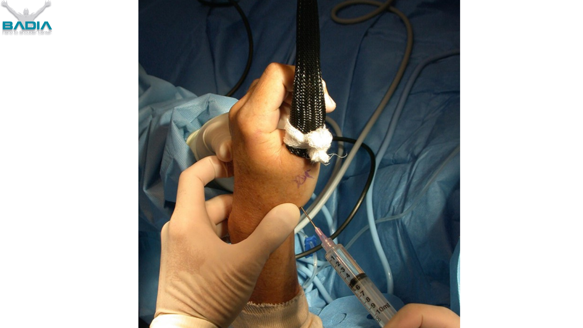 small joint athroscopy thumb