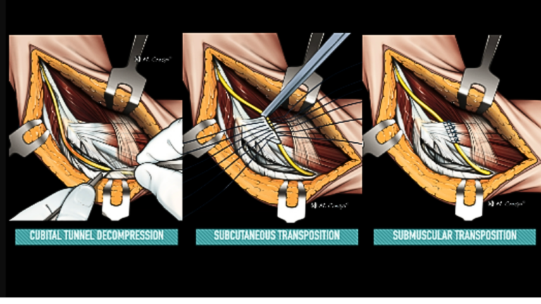 cubital tunnel , ulnar nerve transposition