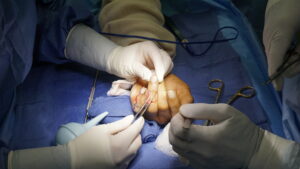 Dr. Badia cross finger flap on patient from trinidad